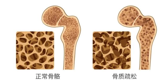 骨质疏松规范诊疗