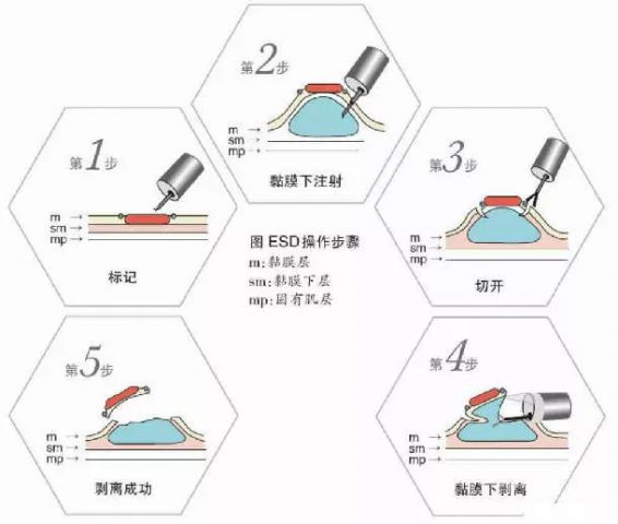 内镜黏膜下剥离术（ESD）