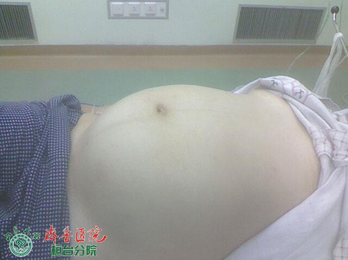 子宫肌瘤患者.jpg