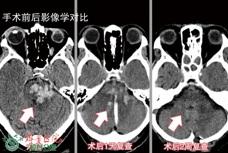 脑干穿刺引流.gif