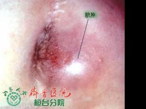 肛周脓肿